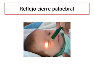 Reflejo cierre palpebral
 