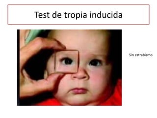 Test de tropia inducida
Sin estrabismo
 
