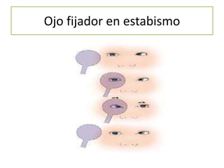 Ojo fijador en estabismo
 