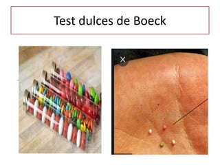 Test dulces de Boeck
 