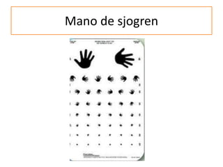 Mano de sjogren
 