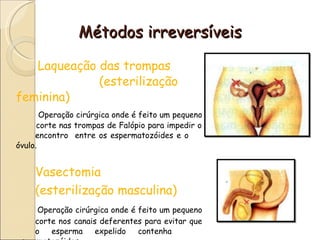 Métodos irreversíveis Laqueação das trompas  (esterilização feminina) Operação cirúrgica onde é feito um pequeno  corte nas trompas de Falópio para impedir o  encontro  entre os espermatozóides e o  óvulo. Vasectomia  (esterilização masculina) Operação cirúrgica onde é feito um pequeno  corte nos canais deferentes para evitar que  o esperma expelido contenha  espermatozóides. 