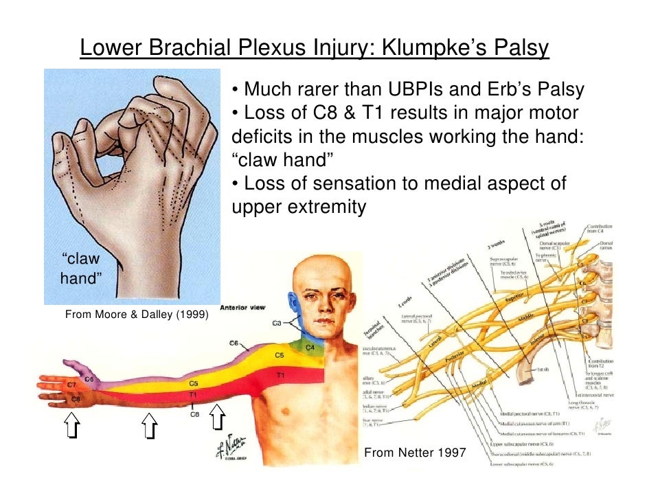 Klumpkes Palsy Brachial Plexus Injury C8 To T1