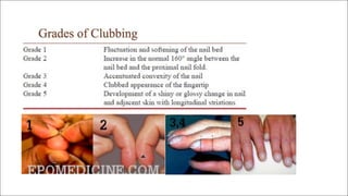 Clubbing Pathophysiology Notes Pediatrics - Pulse Oximetry and Clubbing (concise) | PDF