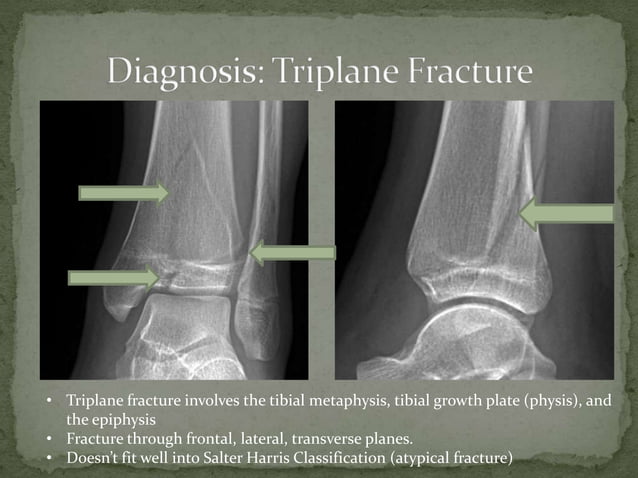 Triplane Fracture | PPT