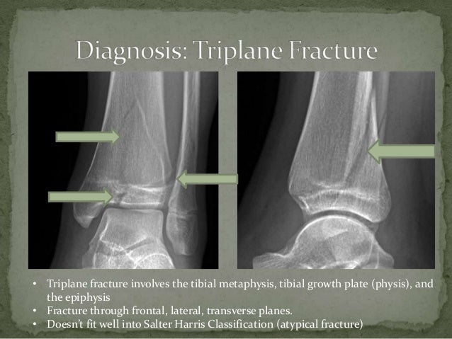 Triplane Fracture