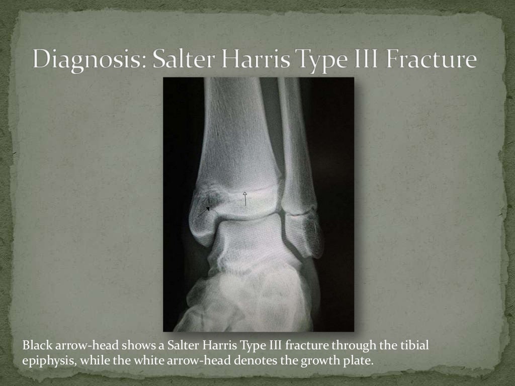 salter harris fracture classification salter harris fracture classification