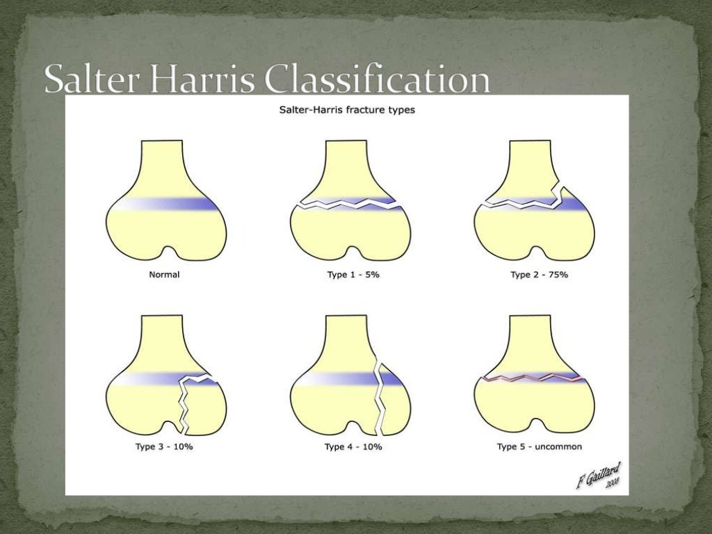 Salter Harris Type 3 Fracture