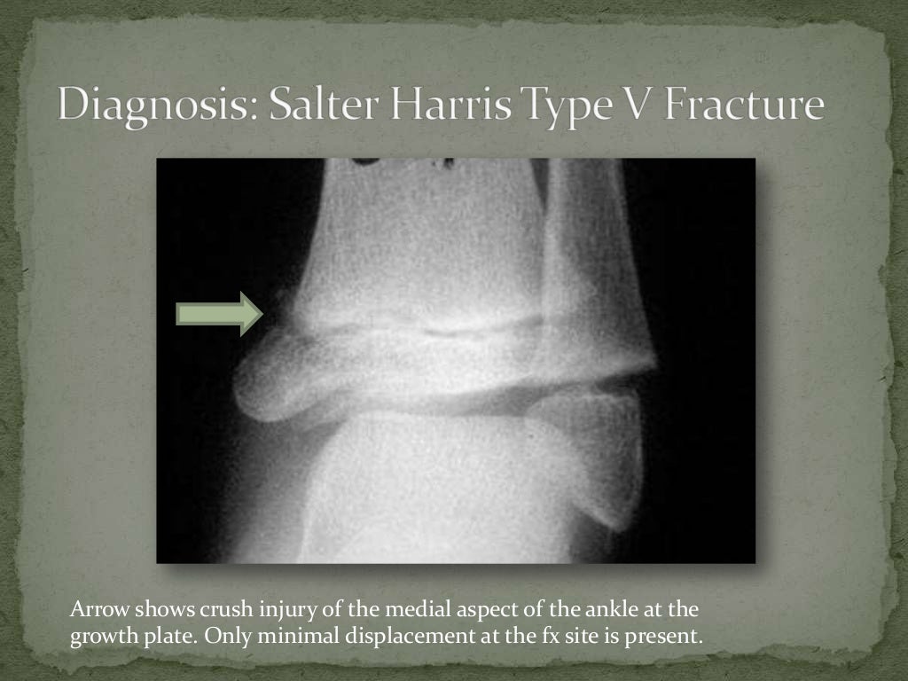 Salter Harris Type 5 Fracture