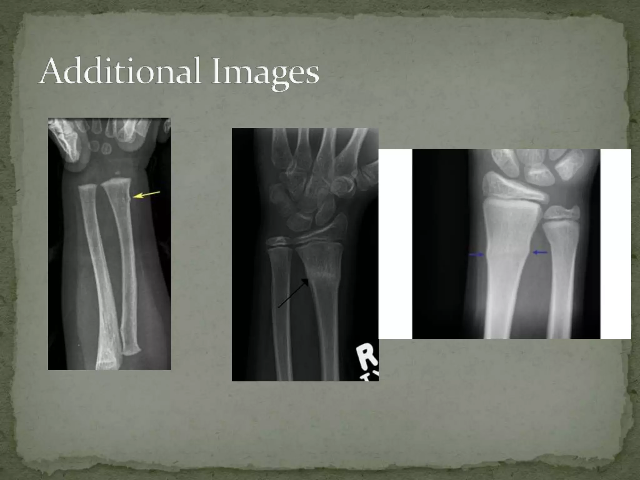 Torus Fracture | PPT