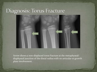 Arrow shows a non-displaced torus fracture at the metaphysealdiaphyseal junction of the distal radius with no articular or growth
plate involvement.

 