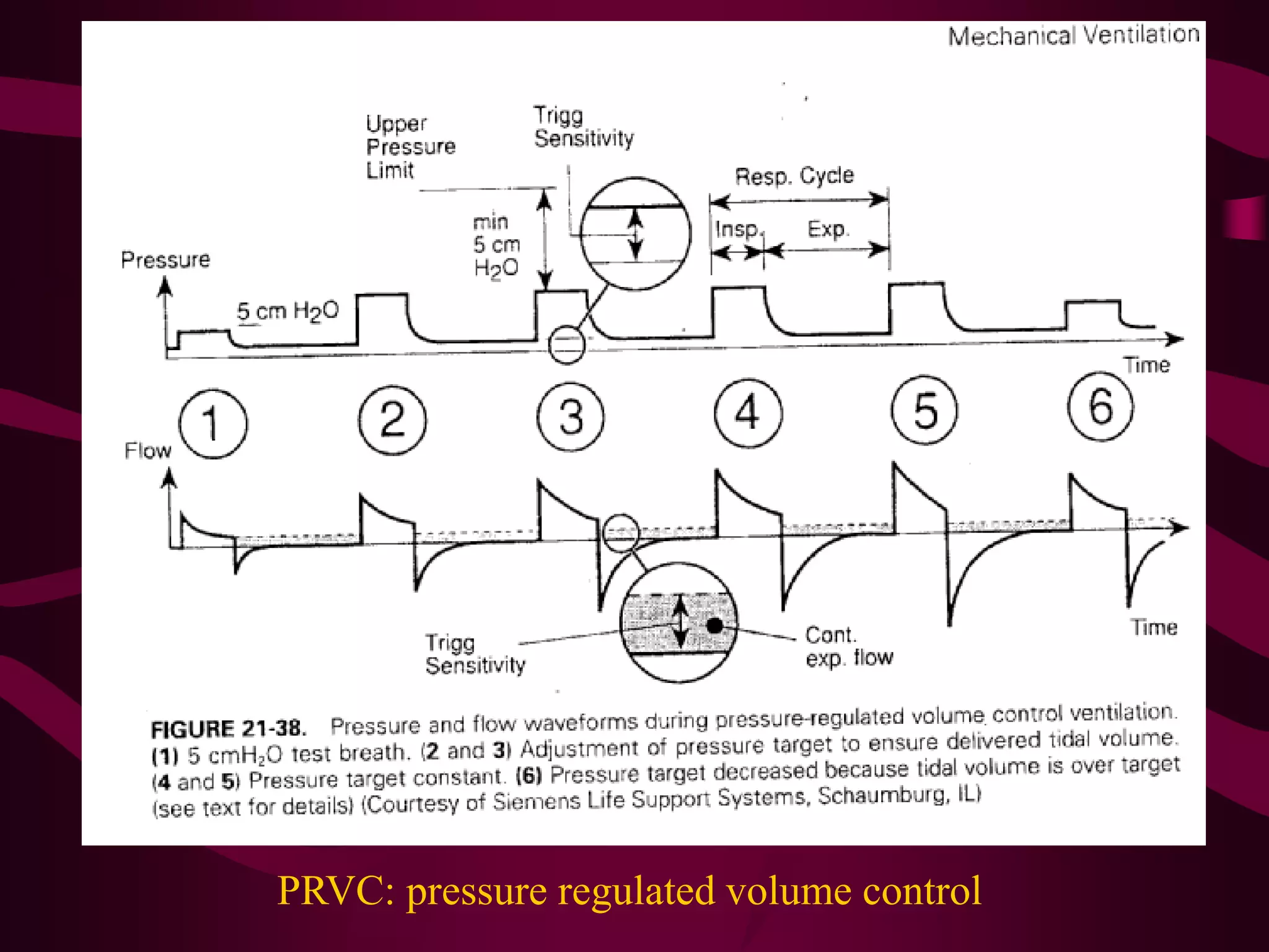 PRVC: pressure regulated volume control
 