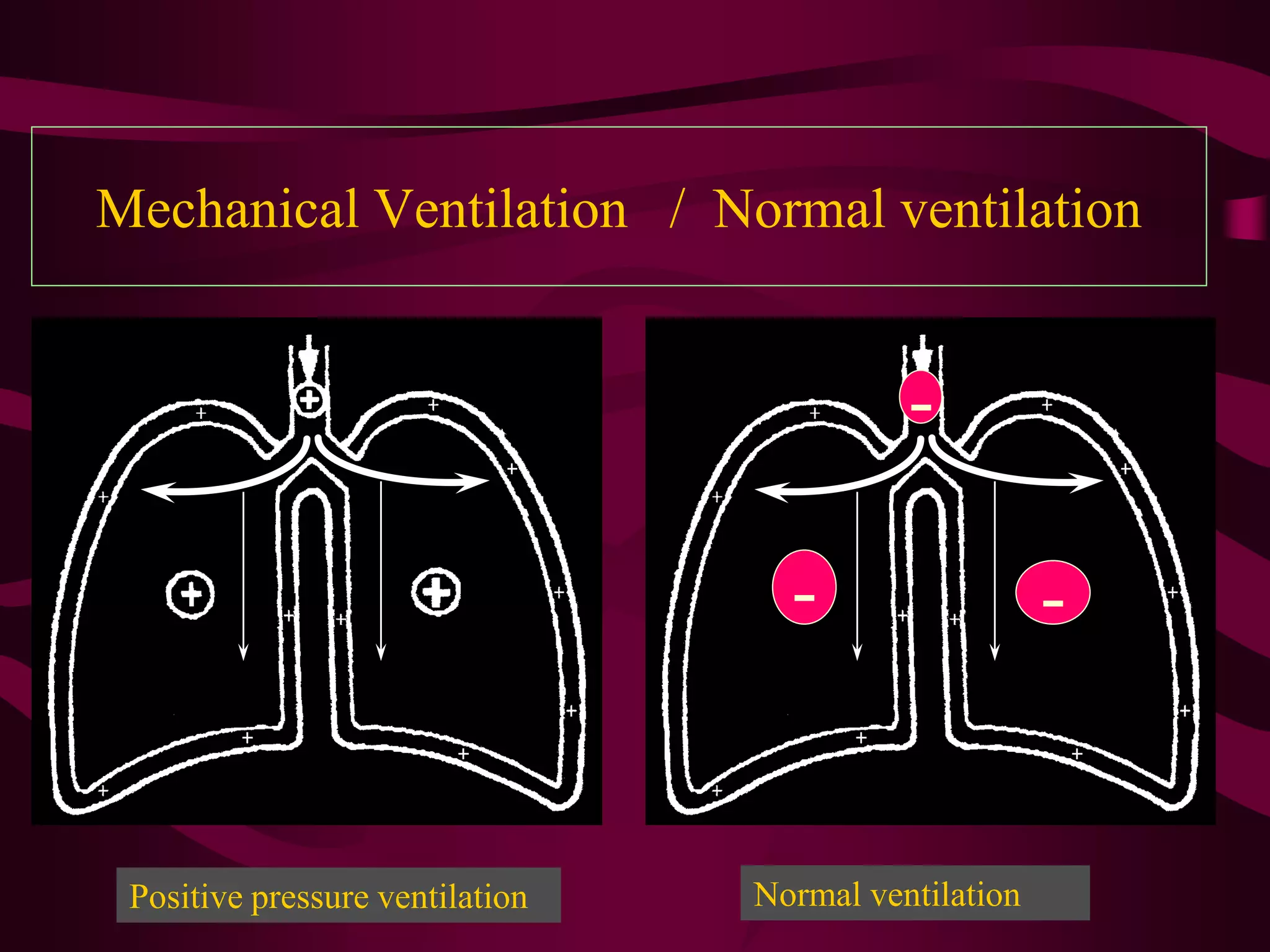 Mechanical Ventilation / Normal ventilation


                                           -

                                   -                  -


 Positive pressure ventilation   Normal ventilation
 