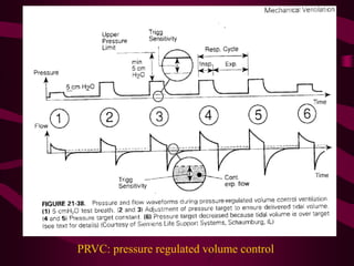 PRVC: pressure regulated volume control
 