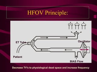 HFOV Principle:



  ET Tube                                             Oscillator




Patient
                                               BIAS Flow

Decrease TV’s to physiological dead space and increase frequency
 