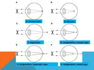 A: Emmetropia. B: Myopia.
C: Hyperopia. D: Astigmatism, myopic type.
E: Astigmatism, hyperopic type. F: Astigmatism, mixed type
 