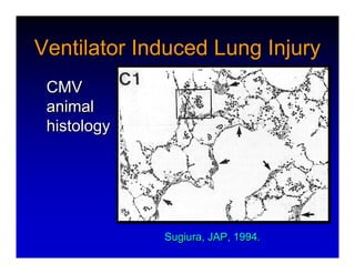High Frequency Ventillation