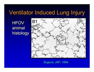 High Frequency Ventillation