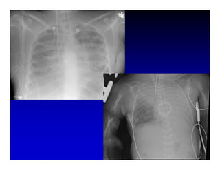 High Frequency Ventillation
