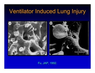 High Frequency Ventillation
