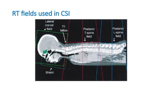 Rt Field role of RT in pediatric CNS Tumors .pptx