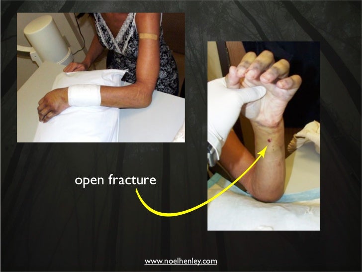 Pediatric Hand Injuries Evaluation, Diagnosis