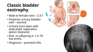 Comprehensive Pediatric Urogenital Surgery: Hypospadias and Exstrophy ...