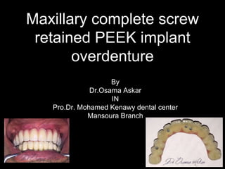 Maxillary complete screw
retained PEEK implant
overdenture
By
Dr.Osama Askar
IN
Pro.Dr. Mohamed Kenawy dental center
Mansoura Branch
 