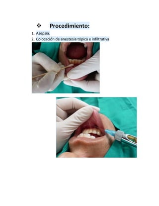  Procedimiento:
1. Asepsia.
2. Colocación de anestesia tópica e infiltrativa