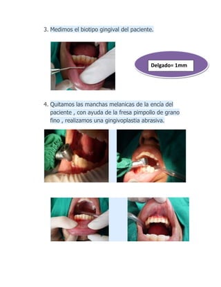 3. Medimos el biotipo gingival del paciente.
4. Quitamos las manchas melanicas de la encía del
paciente , con ayuda de la fresa pimpollo de grano
fino , realizamos una gingivoplastia abrasiva.
Delgado= 1mm