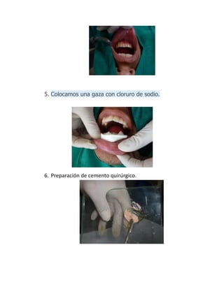 5. Colocamos una gaza con cloruro de sodio.
6. Preparación de cemento quirúrgico.
.