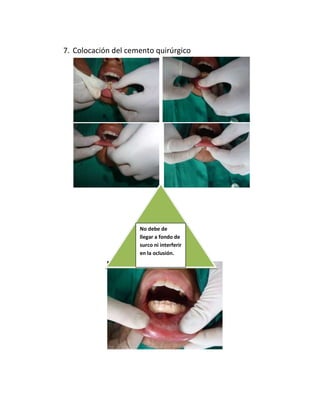 7. Colocación del cemento quirúrgico
No debe de
llegar a fondo de
surco ni interferir
en la oclusión.