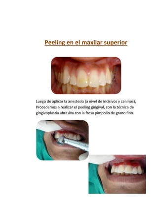 Peeling en el maxilar superior
Luego de aplicar la anestesia (a nivel de incisivos y caninos),
Procedemos a realizar el peeling gingival, con la técnica de
gingivoplastia abrasiva con la fresa pimpollo de grano fino.