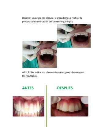 Dejamos una gaza con cloruro, y procedemos a realizar la
preparación y colocación del cemento quirúrgico
A los 7 días, retiramos el cemento quirúrgico y observamos
los resultados.
ANTES DESPUES