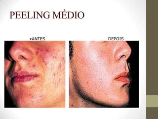 PEELING MÉDIO
 