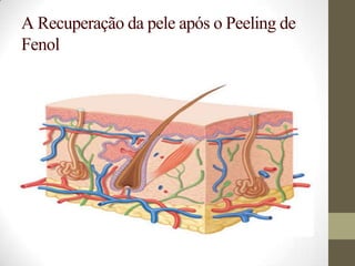 A Recuperação da pele após o Peeling de
Fenol
 