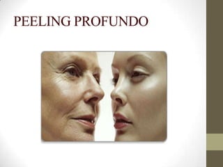 PEELING PROFUNDO
 
