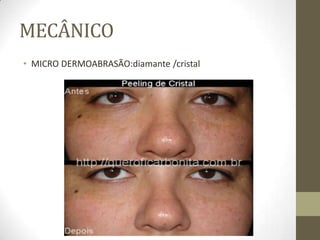 MECÂNICO
• MICRO DERMOABRASÃO:diamante /cristal
 