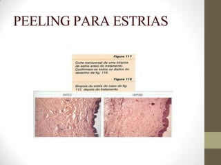 PEELING PARA ESTRIAS
 