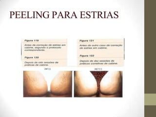 PEELING PARA ESTRIAS
 