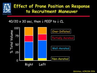 Effect of Prone Position on Response to Recruitment Maneuver % Total Volume Right Left 100 75 50 25 0 Galiatsou, AJRCCM 2006 Over-Inflated Partially Aerated Well-Aerated Non-Aerated 40/20 x 30 sec, then    PEEP to    CL Denver Health 