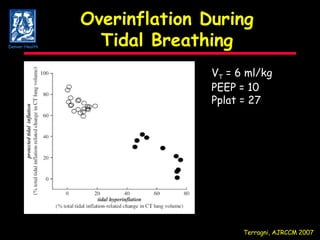 Overinflation During Tidal Breathing V T  = 6 ml/kg PEEP = 10 Pplat = 27 Terragni, AJRCCM 2007 Denver Health 