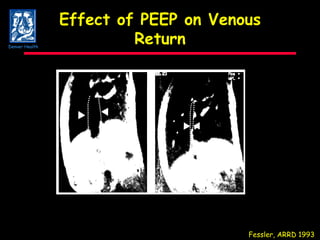 Effect of PEEP on Venous Return Fessler, ARRD 1993 Denver Health 