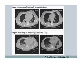 PEEP:Bring the Evidence to the Bedside