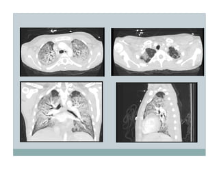 PEEP:Bring the Evidence to the Bedside