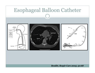 PEEP:Bring the Evidence to the Bedside