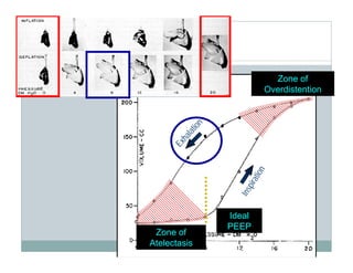 PEEP:Bring the Evidence to the Bedside