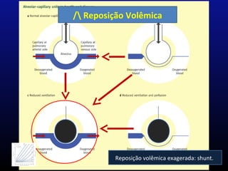/ Reposição Volêmica
PVM
Reposição volêmica exagerada: shunt.
 