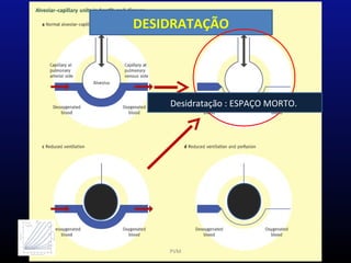 DESIDRATAÇÃO
PVM
Desidratação : ESPAÇO MORTO.
 