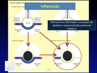 Inflamação
PVM
Biotrauma e inflamação: inundação do
alvélolo e vasoconstrição pulmonar
hipóxica
 